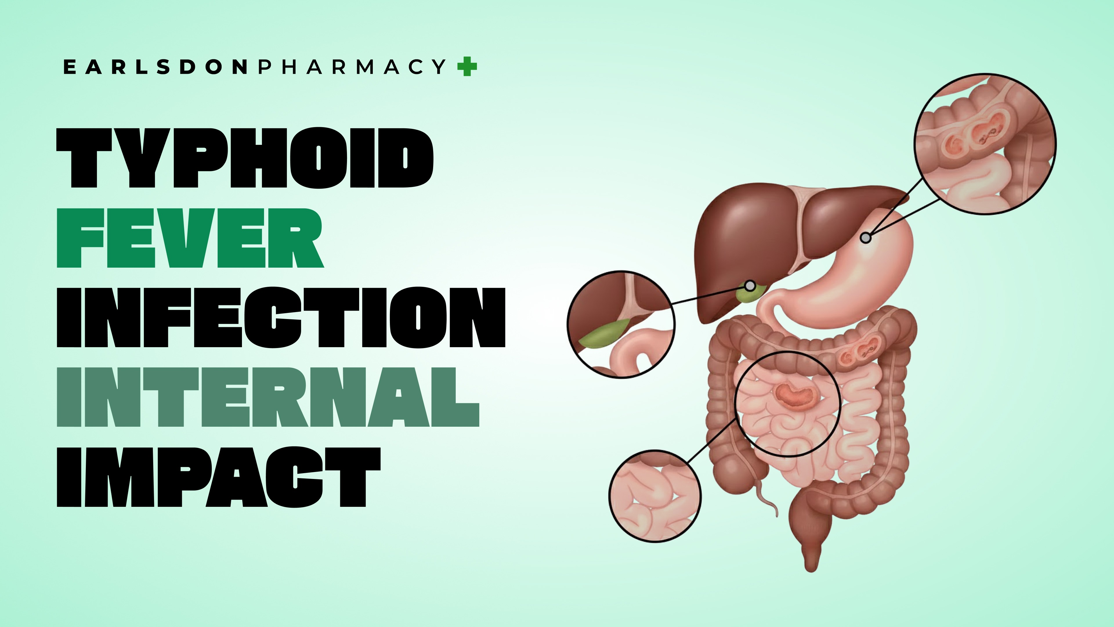 Typhoid Prevention Guide Backed by NHS Information